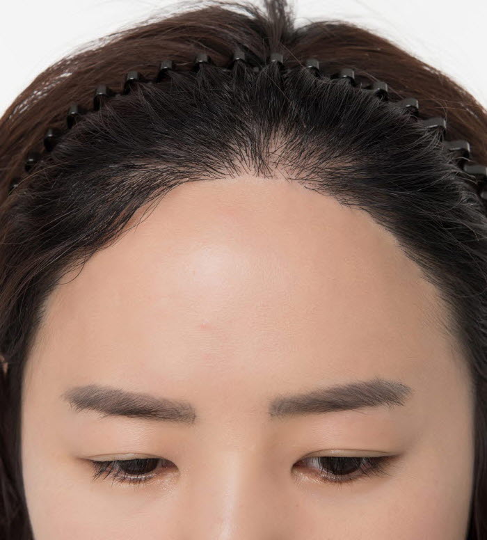 윤헤어라인 디자인 상담 4