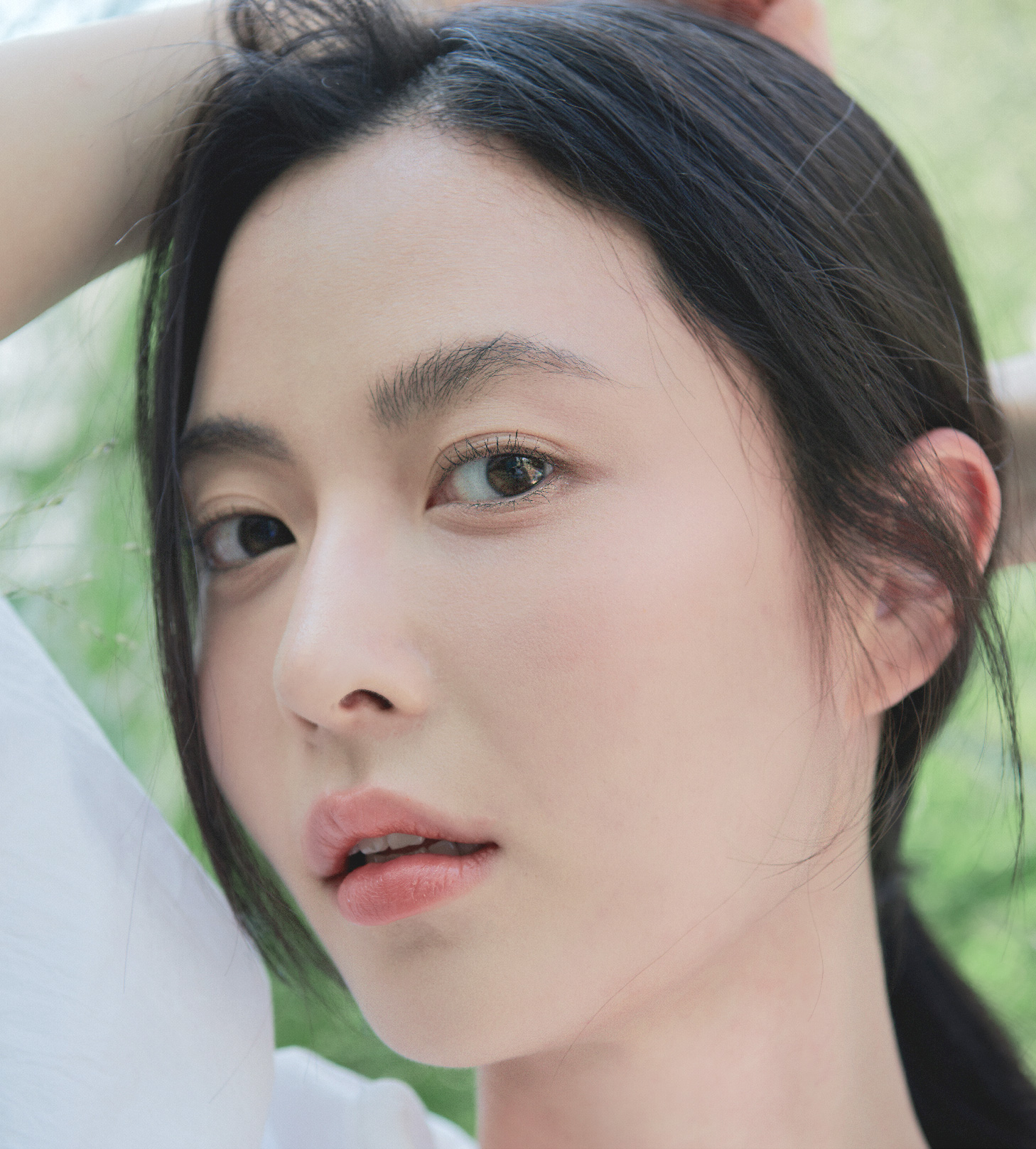 슬릿(slit) 이식 - 채취는 절개, 이식은 헤어라인과 동일하게