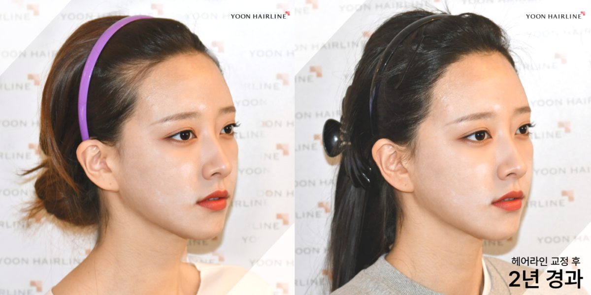 여성 헤어라인 모발이식 2년 경과 비교
