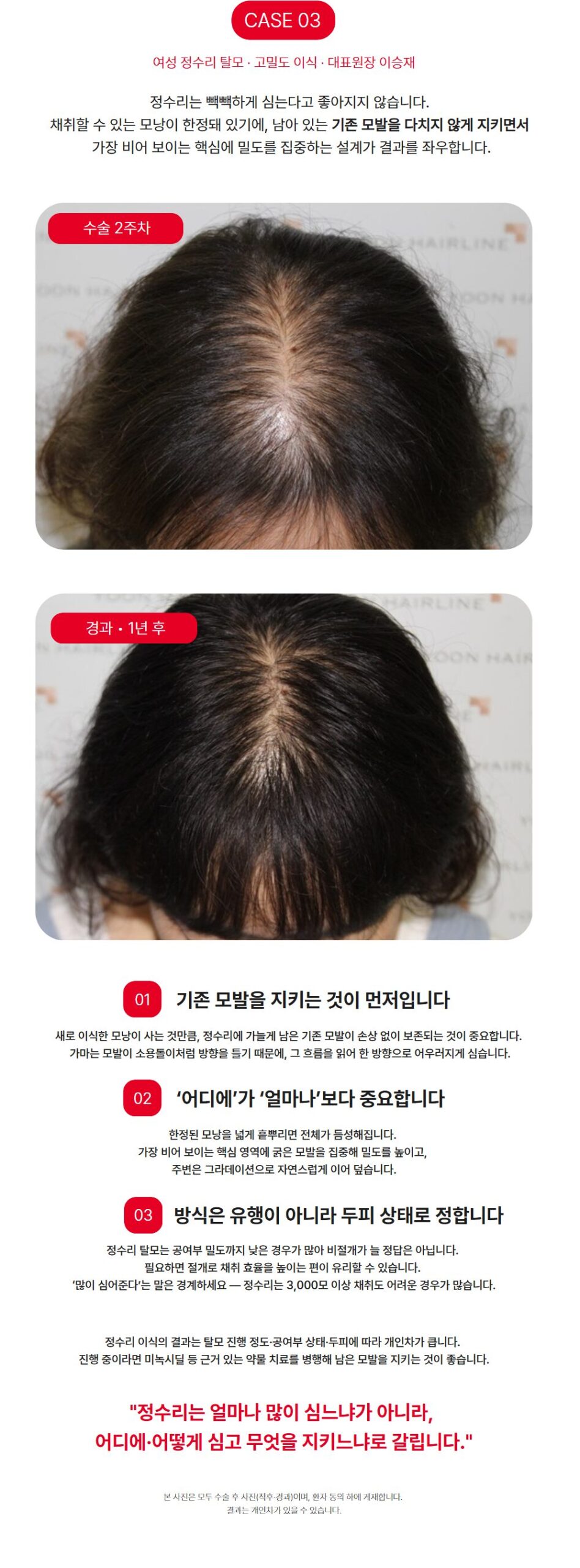 여성 정수리 탈모 고밀도 모발이식 - 수술 2주차와 1년 경과