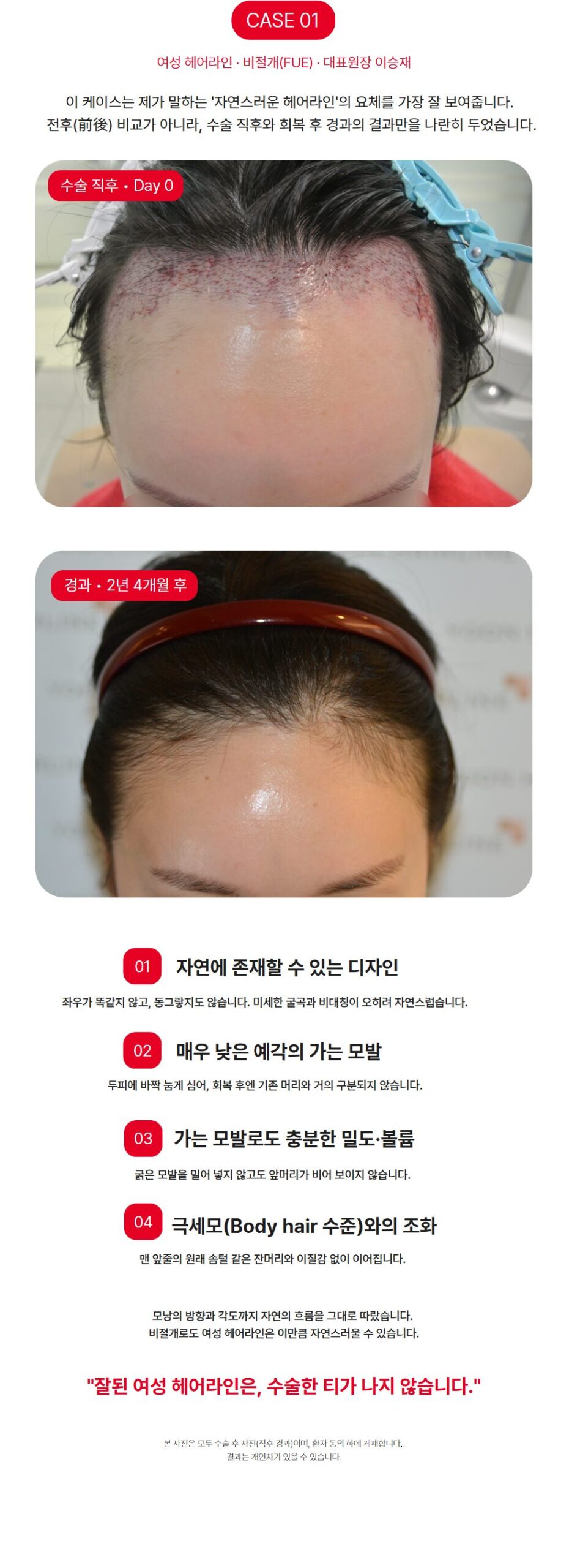 여성 헤어라인 비절개 모발이식 - 수술 직후와 2년 4개월 경과