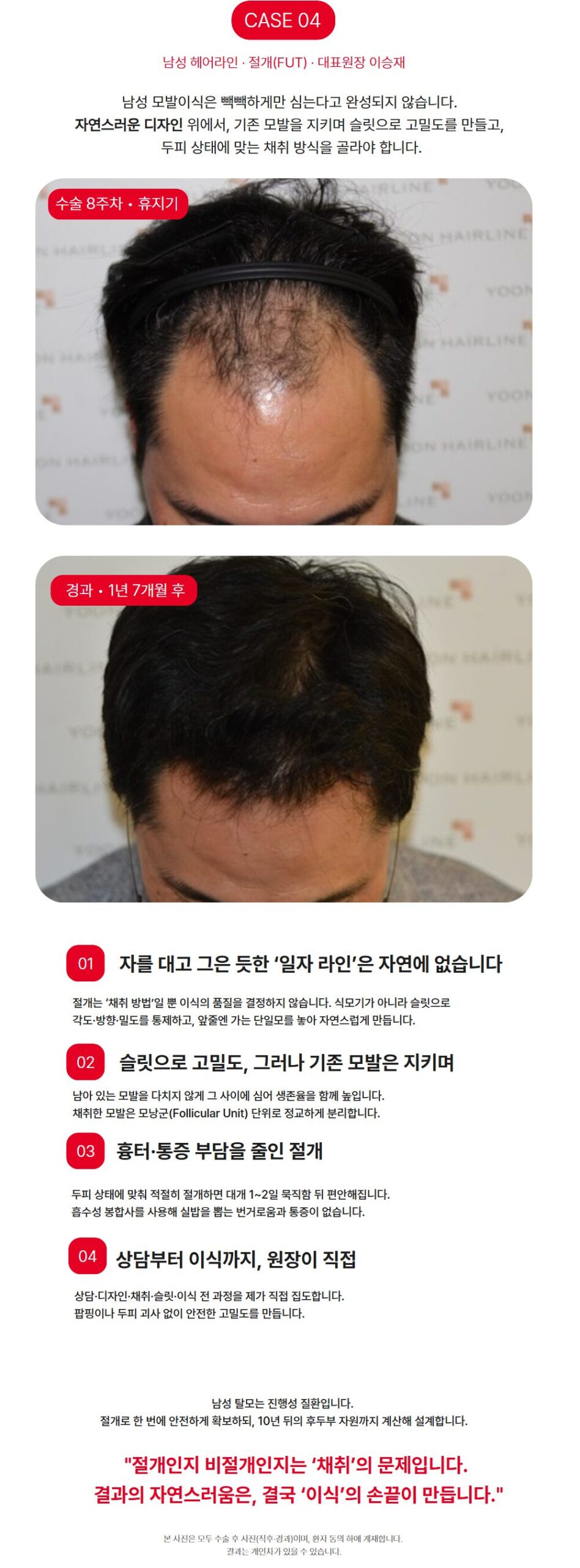 남성 헤어라인 절개 모발이식 - 수술 8주차와 1년 7개월 경과