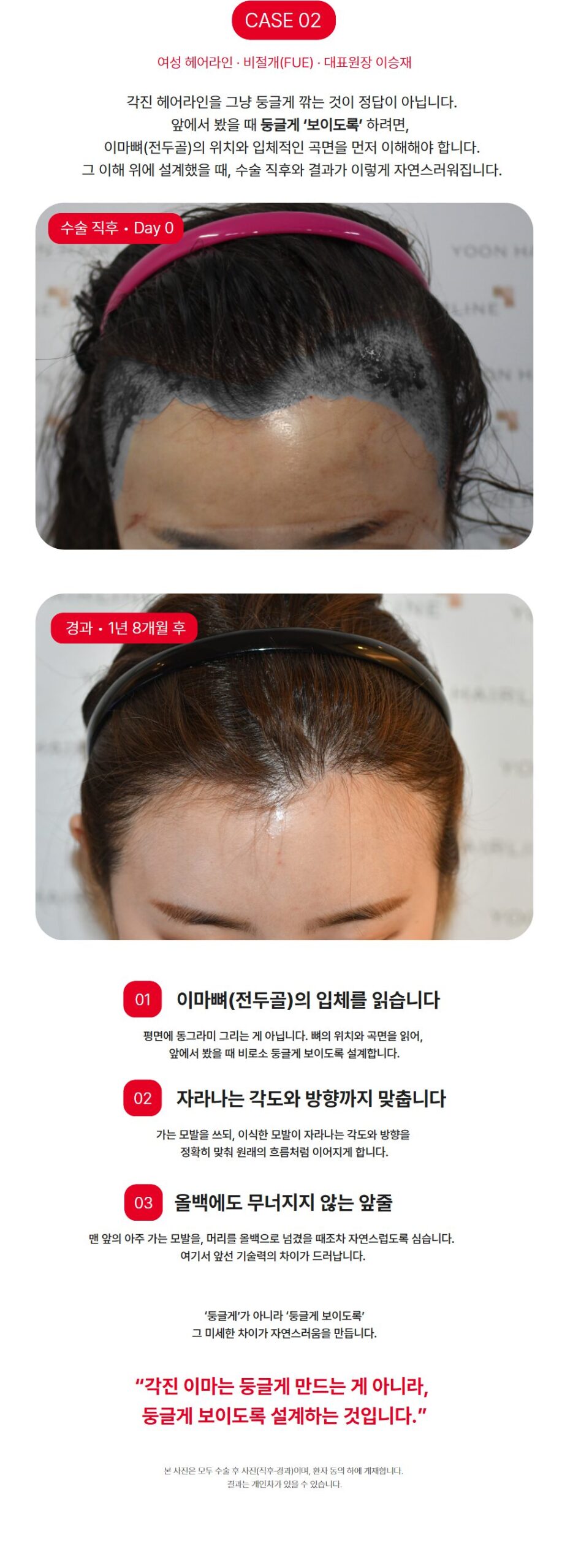 모발이식 후기 - 실제 경과 사진 기록
