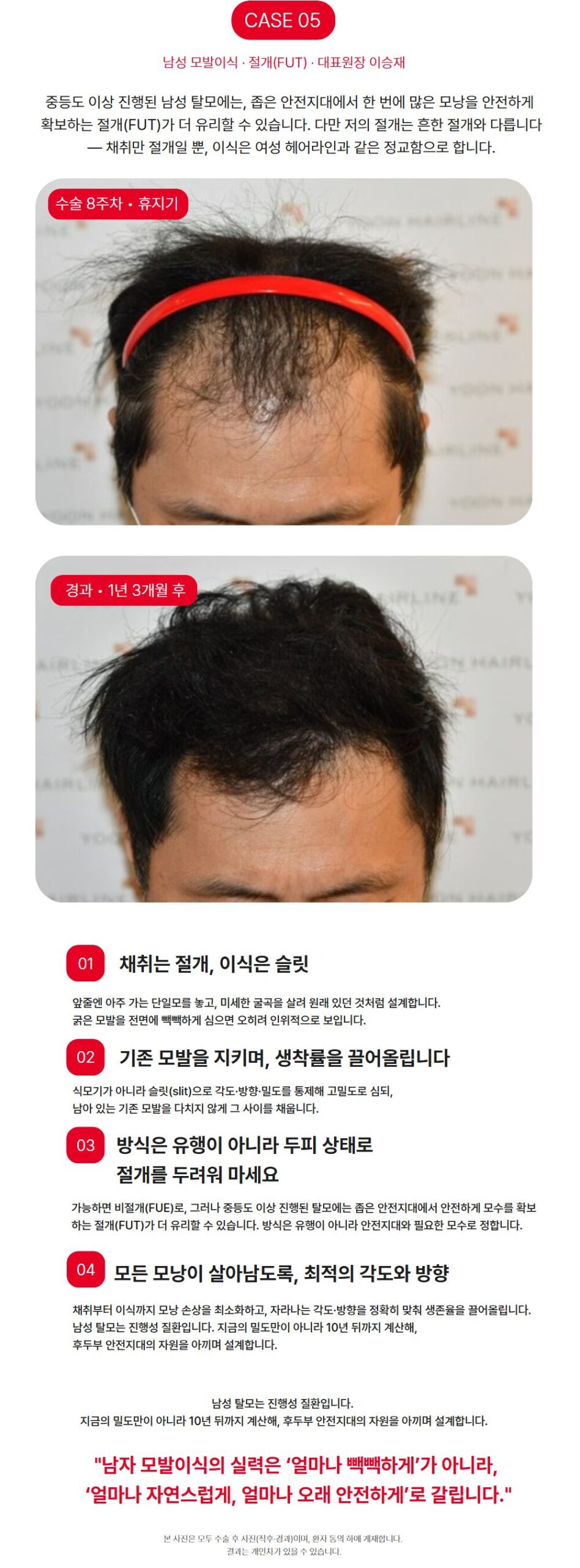 남성 모발이식 절개 - 수술 8주차와 1년 3개월 경과