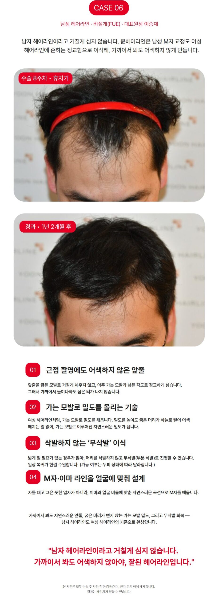 남성 M자 헤어라인 비절개 모발이식 - 수술 8주차와 1년 2개월 경과