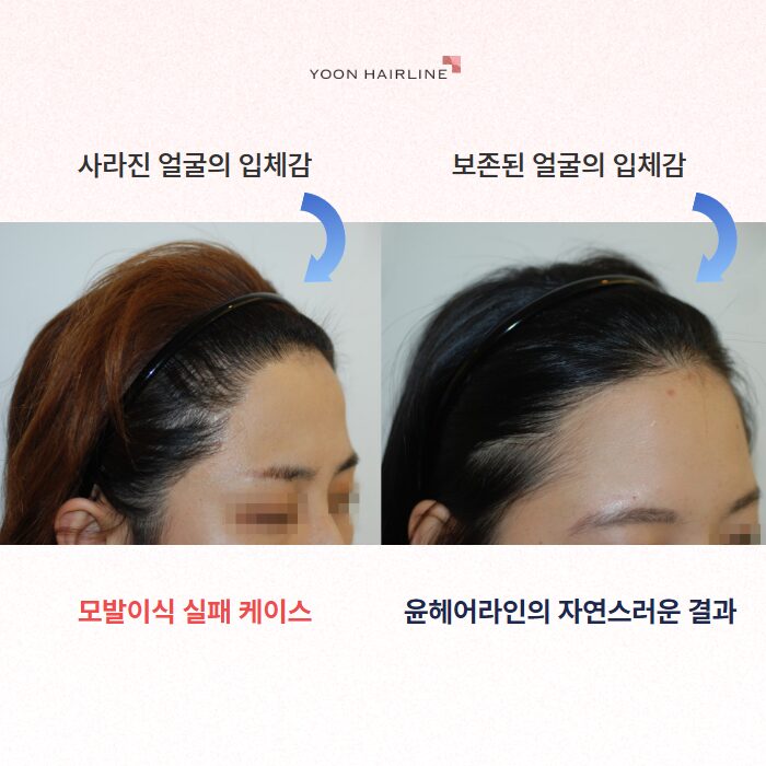 모발이식 재수술 - 어색해진 헤어라인 교정