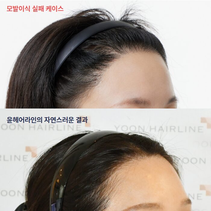 가는 모발 극세모낭 채취 기술