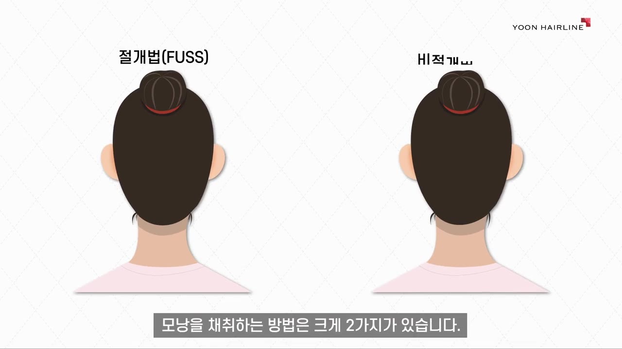 절개(FUT)와 비절개(FUE) 채취 방식 비교 일러스트