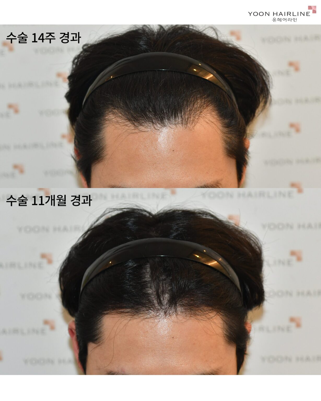 남자모발이식 수술 후 14주 경과와 11개월 경과 – 윤헤어라인 실제 사례