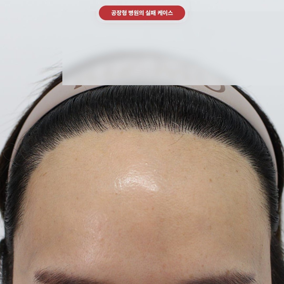 여성 헤어라인 모발이식 단일 아치 설계 결과