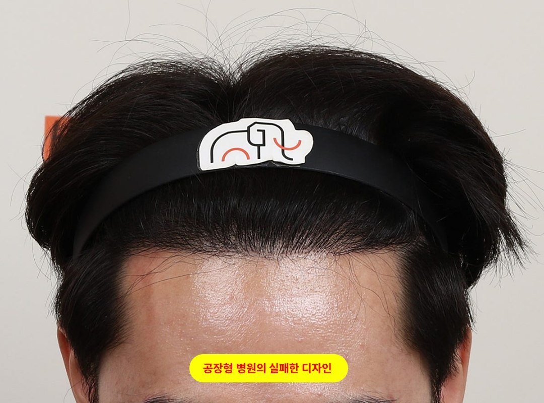 남자 모발이식 직선형 헤어라인 어색한 결과