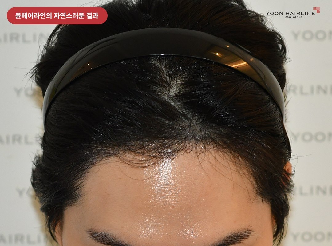 윤헤어라인 남자 M자 탈모 모발이식 자연스러운 결과