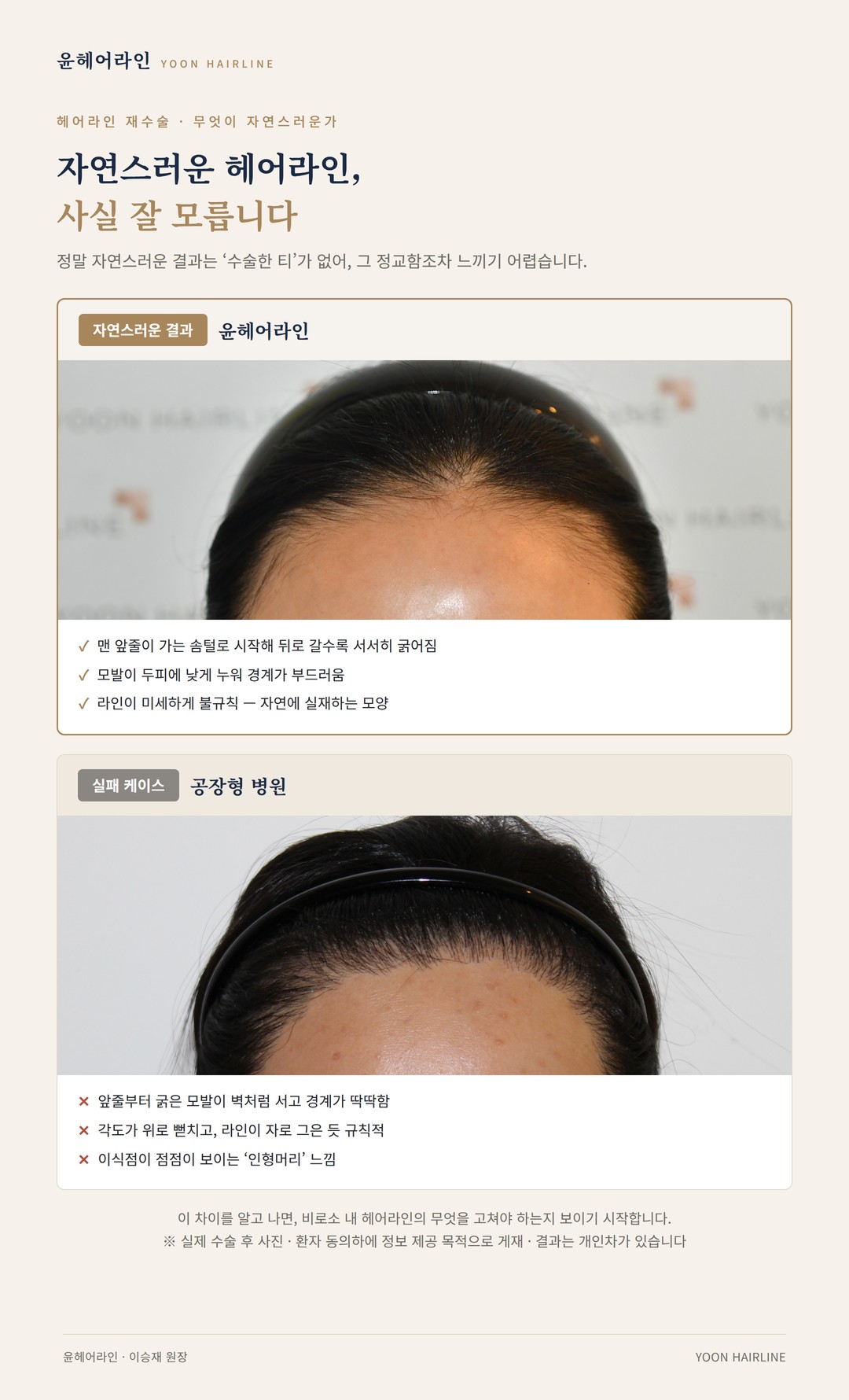 여성 헤어라인 모발이식 결과 비교 – 윤헤어라인의 자연스러운 헤어라인과 공장형 병원 실패 케이스