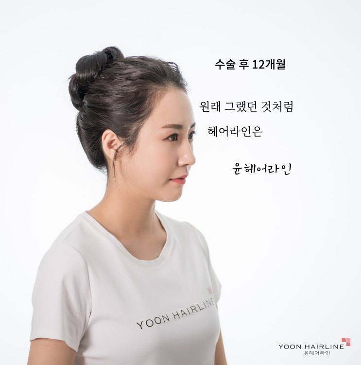 닥승재 블로그 – 여성헤어라인모발이식병원 내돈내산 믿고 했는데