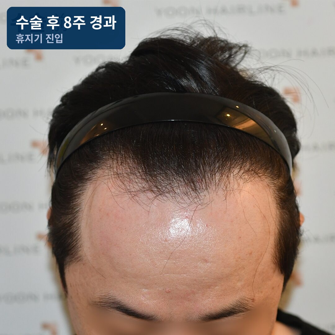 남자모발이식 수술 후 8주 경과 – 휴지기 진입