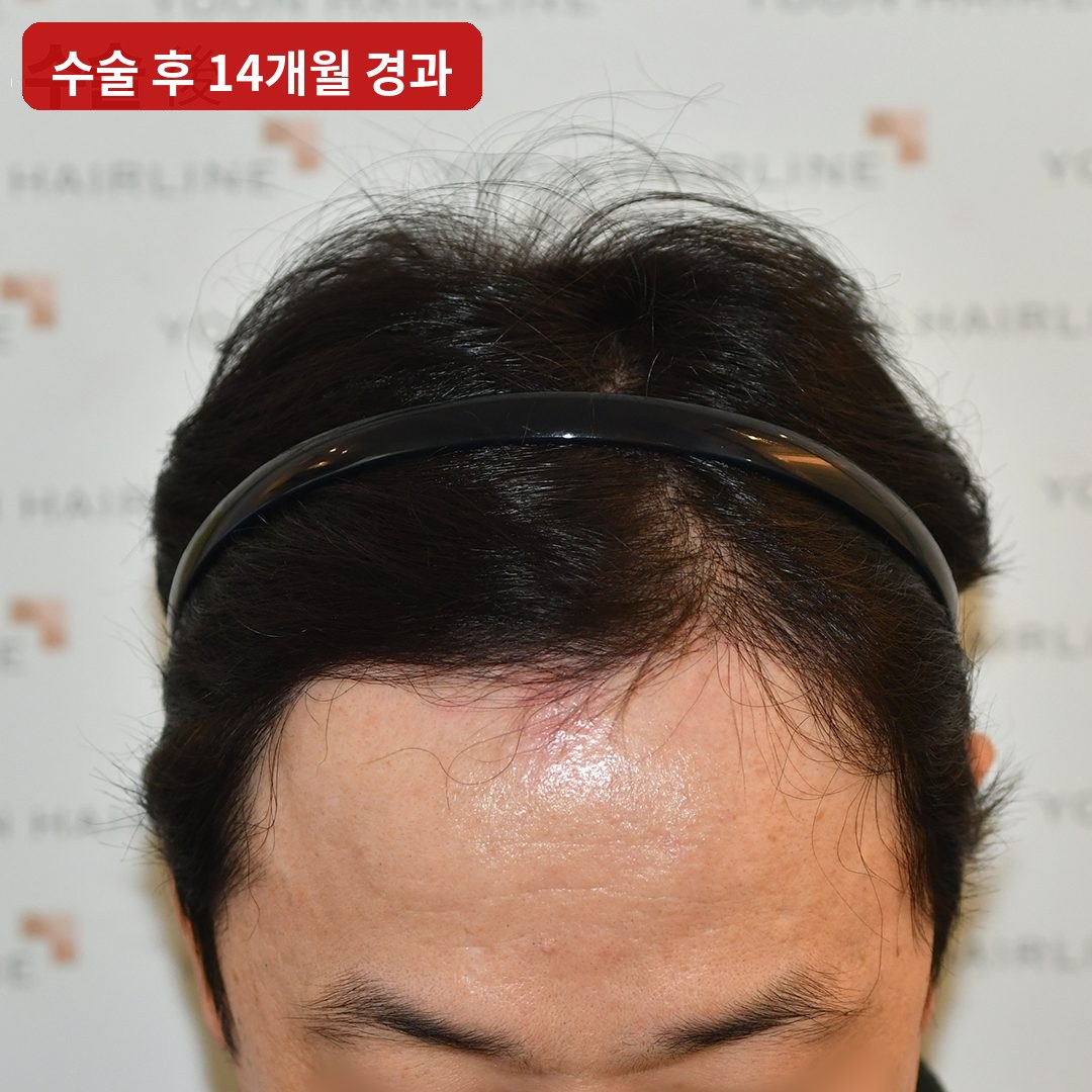 남자모발이식 수술 후 14개월 경과