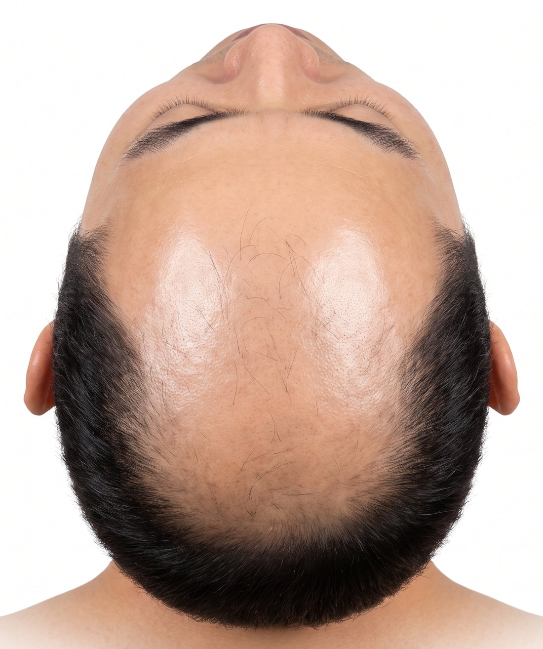 공여부 보존 – 평생 쓸 양이 정해진 후두부