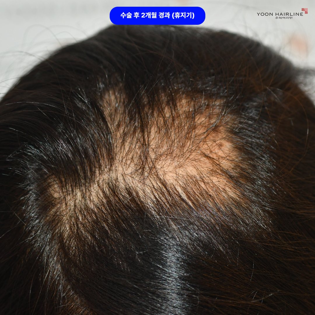 여자 정수리 모발이식 – 휴지기 사이클에 있는 상태로 수술전 상태와 유사한 상태로 돌아가는 경우도 흔히 있습니다.
