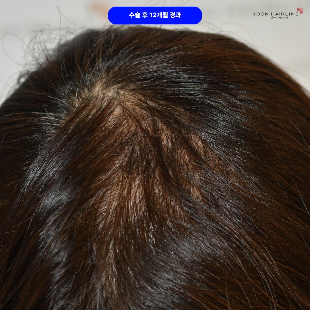 여자 정수리 모발이식 – 수술 후 12개월 경과사진 이식한 모발이 자라서 두피가 비쳐보이는 부분이 사라지고 정수리쪽 볼륨이 증가되었습니다. 볼륨 증가 효과는 향후 2년에 걸쳐서 지속적인 증가가 이루어집니다.