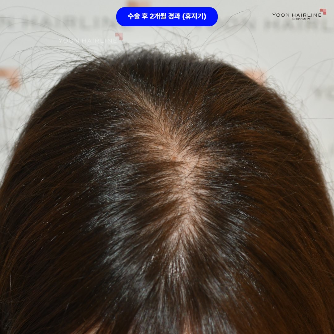 여자 정수리 모발이식 – 휴지기 사이클에 있고 약 3개월~4개월의 휴지기가 지나야 본격적으로 이식된 모낭이 자라기 시작한다.