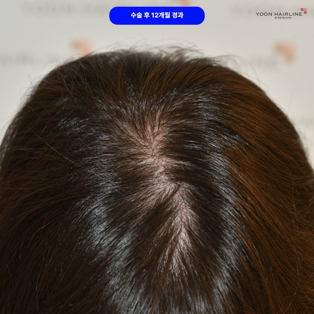 여자 정수리 모발이식 – 수술 후 12개월 경과 휴지기와 비교해 보면 정수리 모발의 절대 부피가 이식된 볼륨만큰 정확히 늘어난 것을 확실히 볼 수 있다.