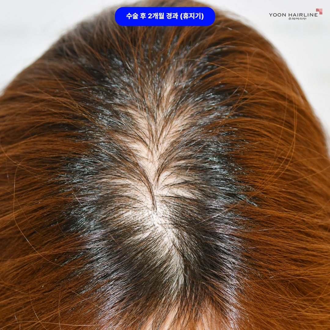 여자 정수리 모발이식 – 휴지기 상태의 두피 일부 이식한 모발이 바로 자라는 모습을 보이지만 이식된 모발의 70%이상이 휴지기 상태에 있어 수술전 상태로 돌아간 것처럼 보인다.