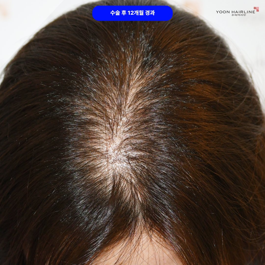 여자 정수리 모발이식 –