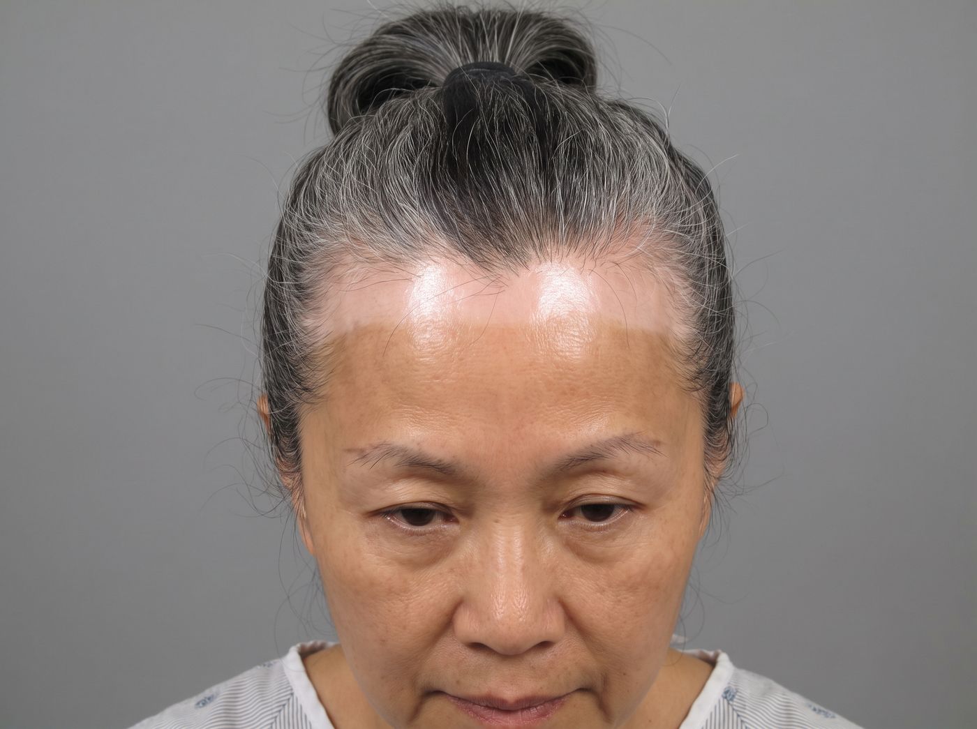 전두섬유성 탈모 임상예 – 이마 위에 창백한 띠가 생기며 헤어라인이 후퇴한 폐경 후 여성