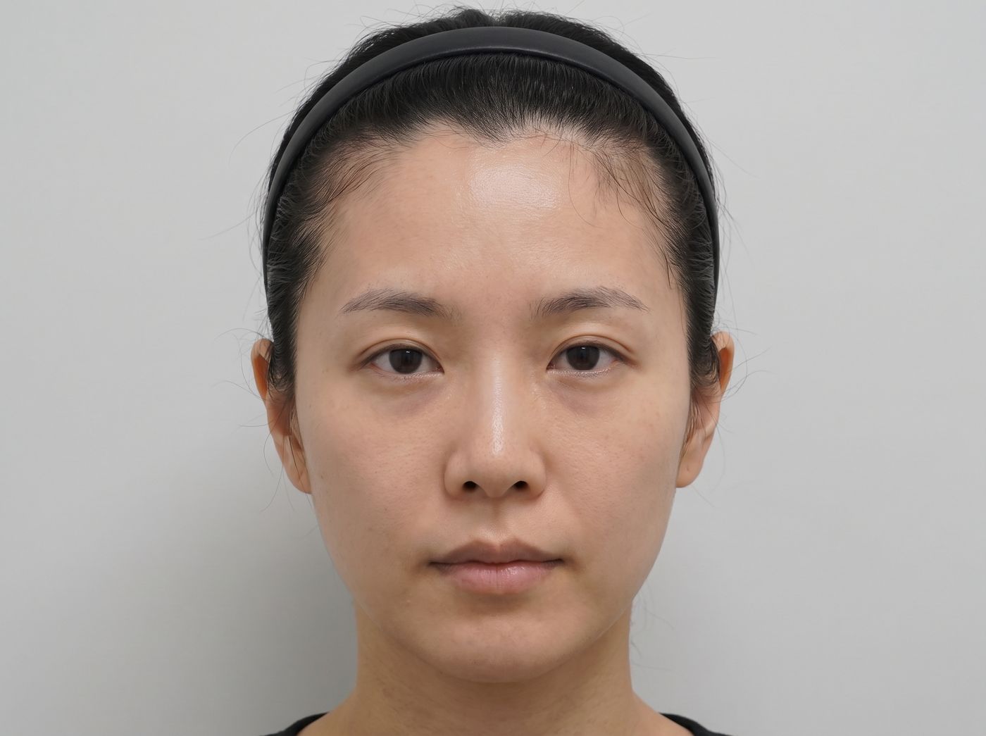 넓은 이마 임상예 – 탈모가 아니라 원래 헤어라인이 높은 여성