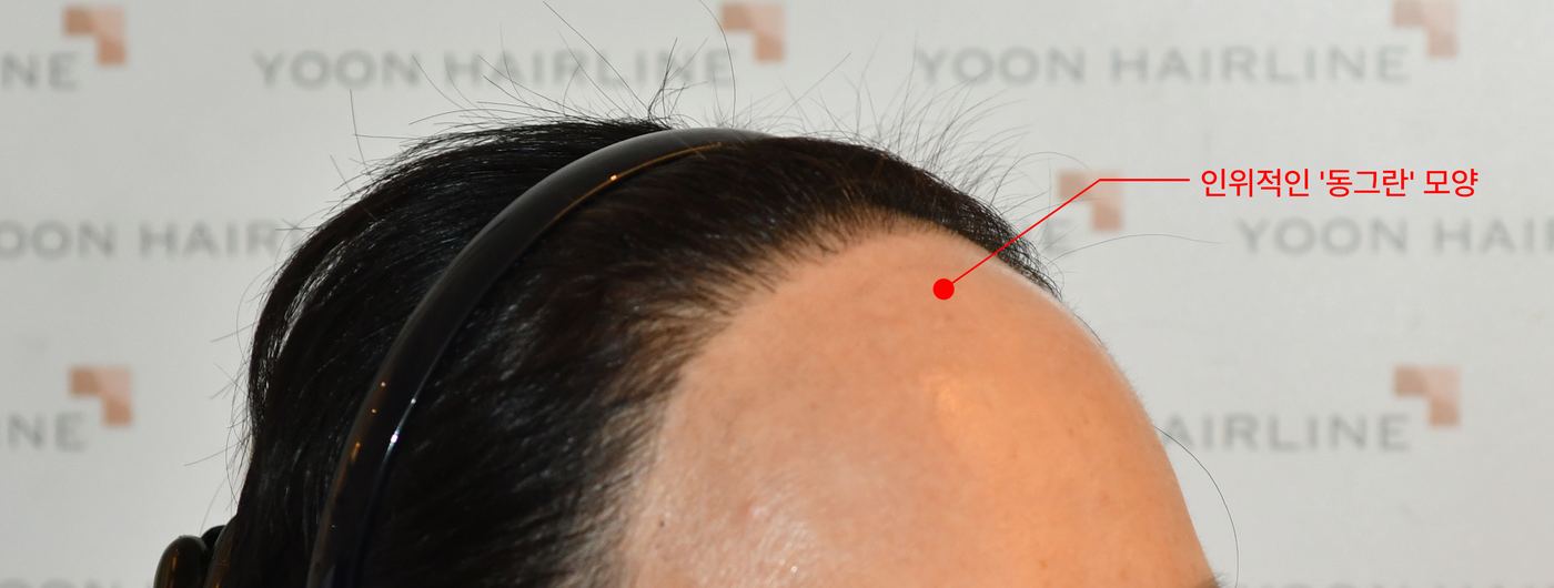 인위적인 둥근 모양으로 표시된 재교정 내원 사례