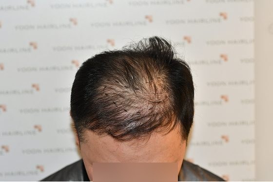 남자 모발이식 재수술 증례 1 – 재수술 전 정수리