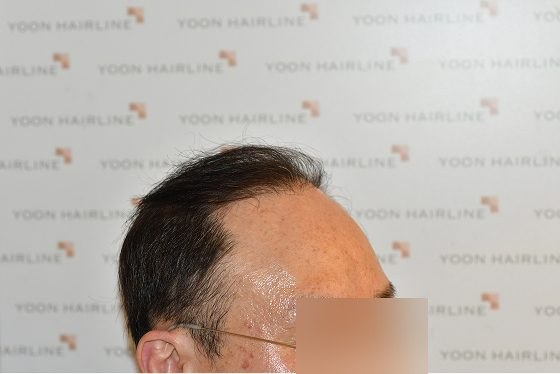 남자 모발이식 재수술 증례 2 – 재수술 후