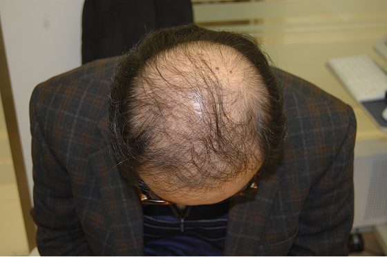 남자 모발이식 재수술 증례 2 – 재수술 전