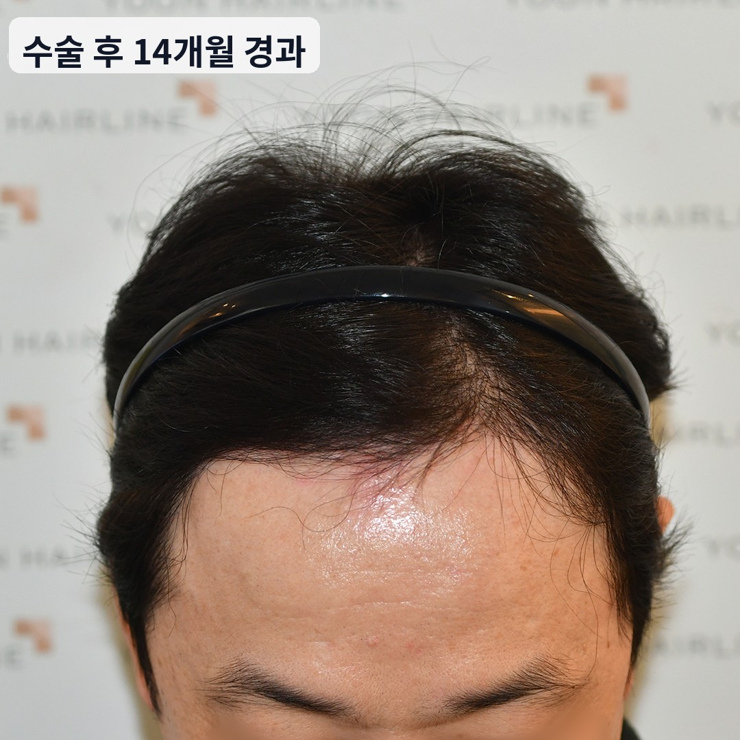 남자 모발이식 수술 후 14개월 경과 — 앞머리와 M자 부위