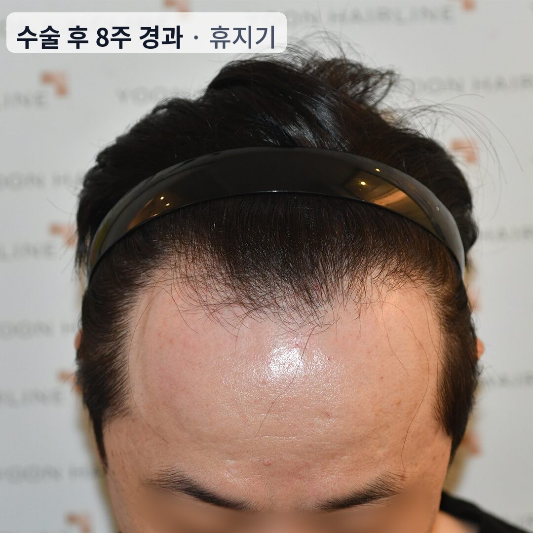 남자 모발이식 수술 후 8주 경과 휴지기 — 심은 모발이 빠져 수술 전과 비슷해 보이는 시기