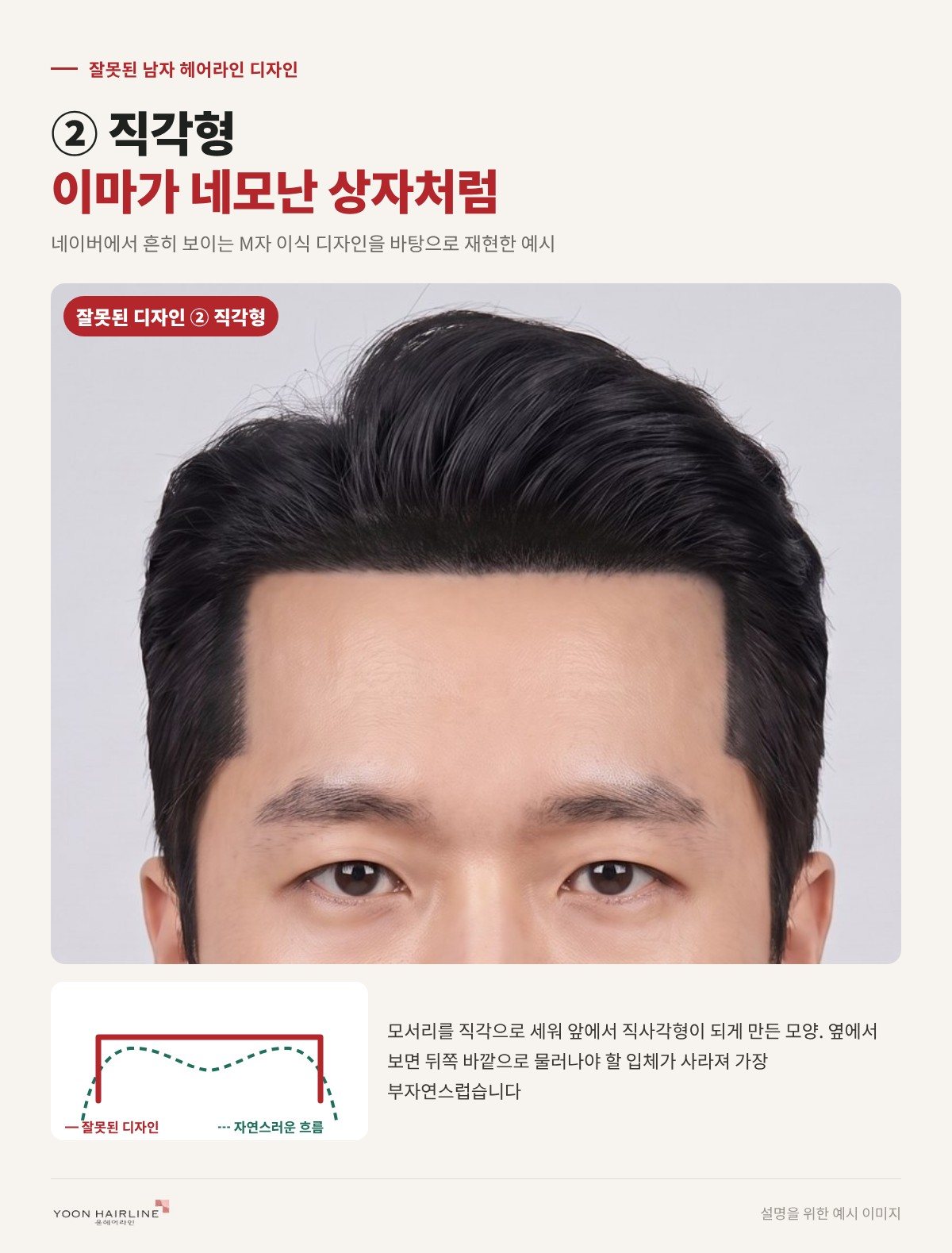 잘못된 남자 헤어라인 디자인 직각형 — 이마가 네모난 상자처럼 보이는 라인