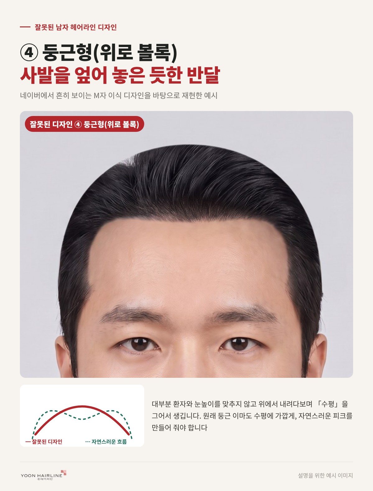 잘못된 남자 헤어라인 디자인 둥근형 — 사발을 엎어 놓은 듯한 반달