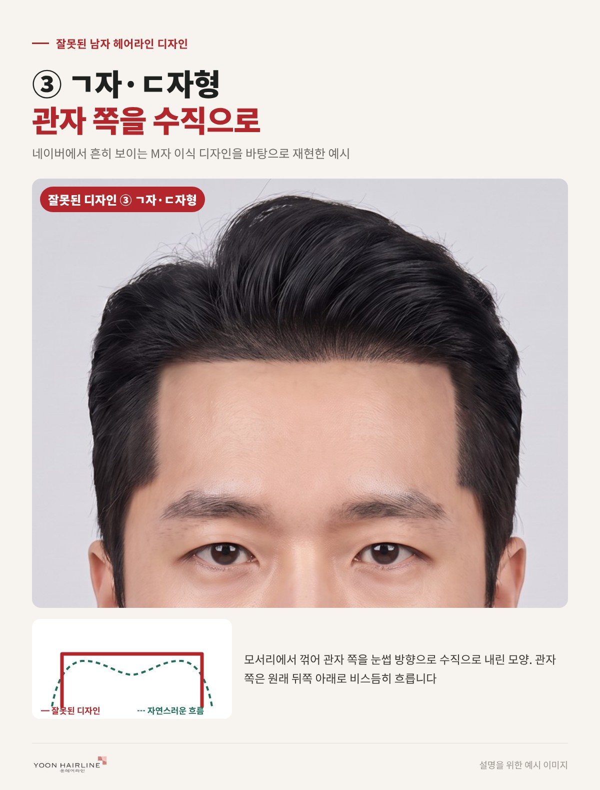 잘못된 남자 헤어라인 디자인 ㄷ자형 — 관자 쪽을 수직으로 내린 라인