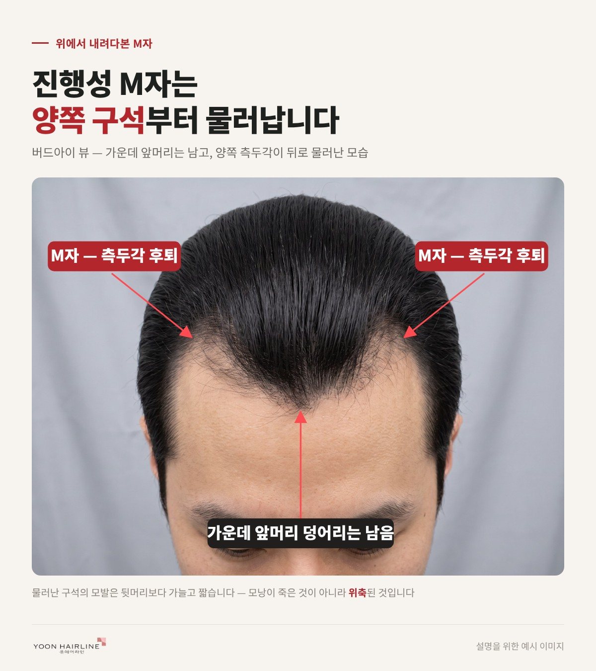 진행성 M자 탈모는 양쪽 구석부터 물러나는 모습을 위에서 본 예시