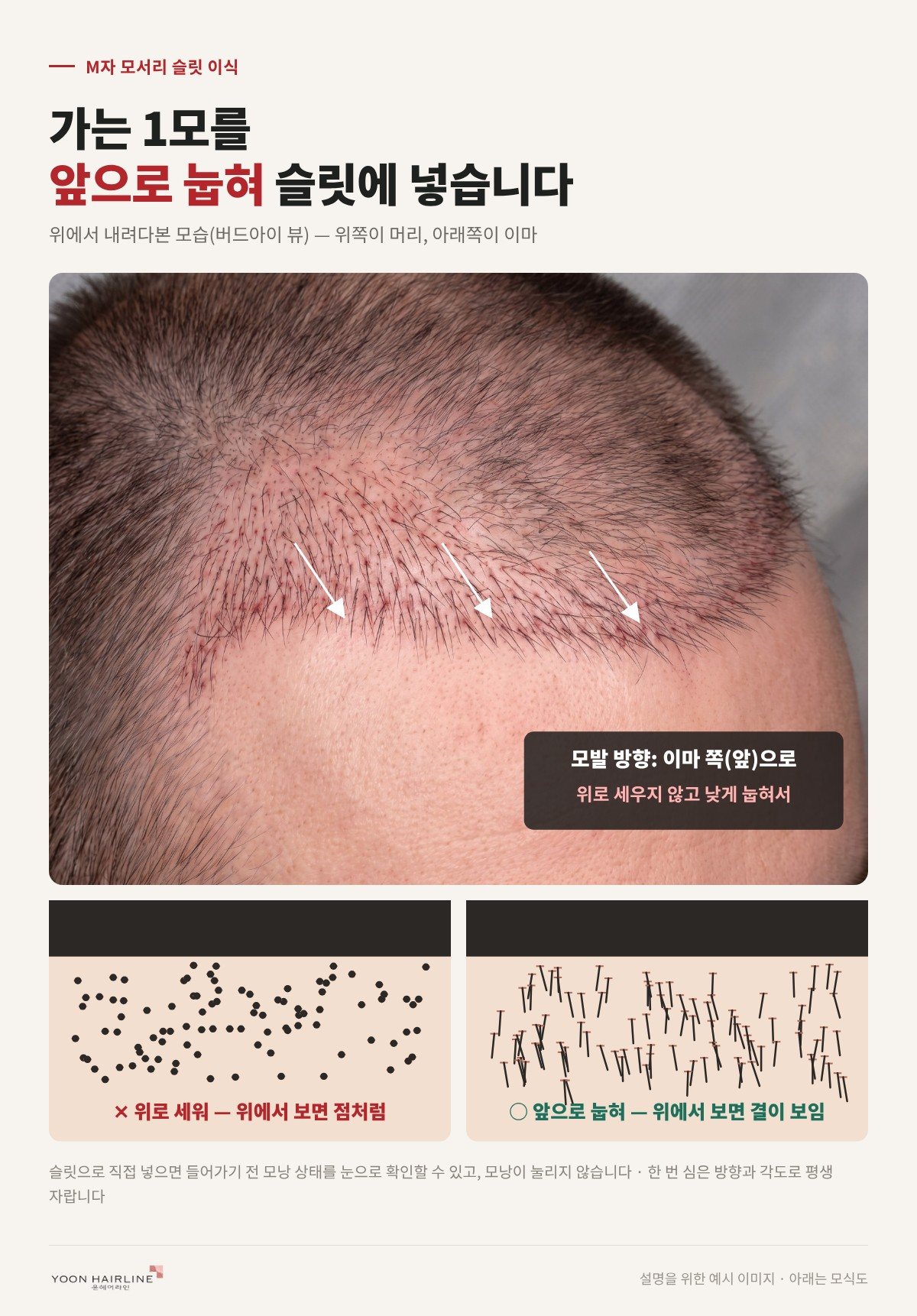 가는 1모를 앞으로 눕혀 슬릿에 넣는 남자 헤어라인 이식 예시