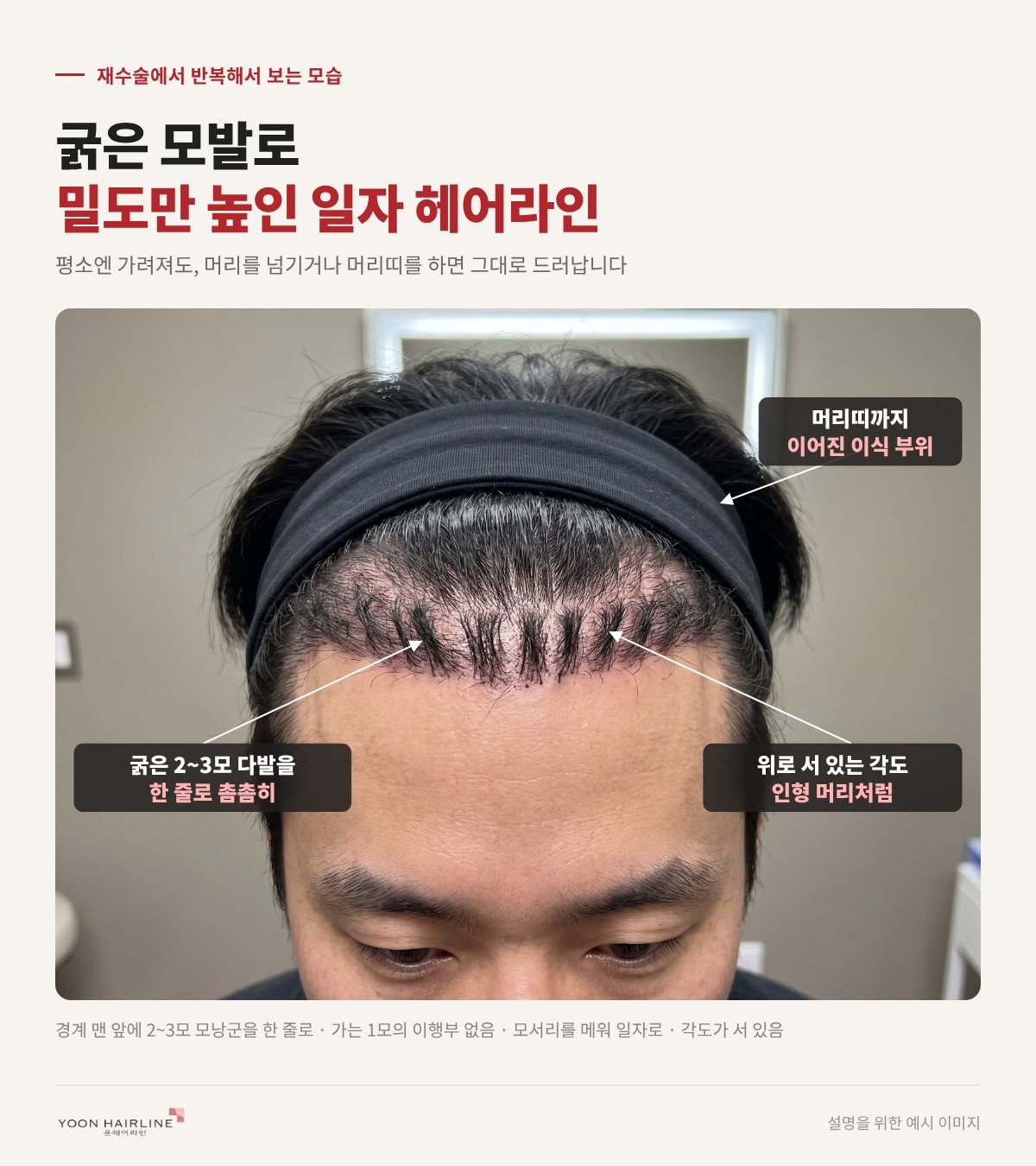 굵은 모발로 밀도만 높인 일자 헤어라인 — 재수술에서 반복해서 보는 모습