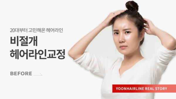 장화선 비포